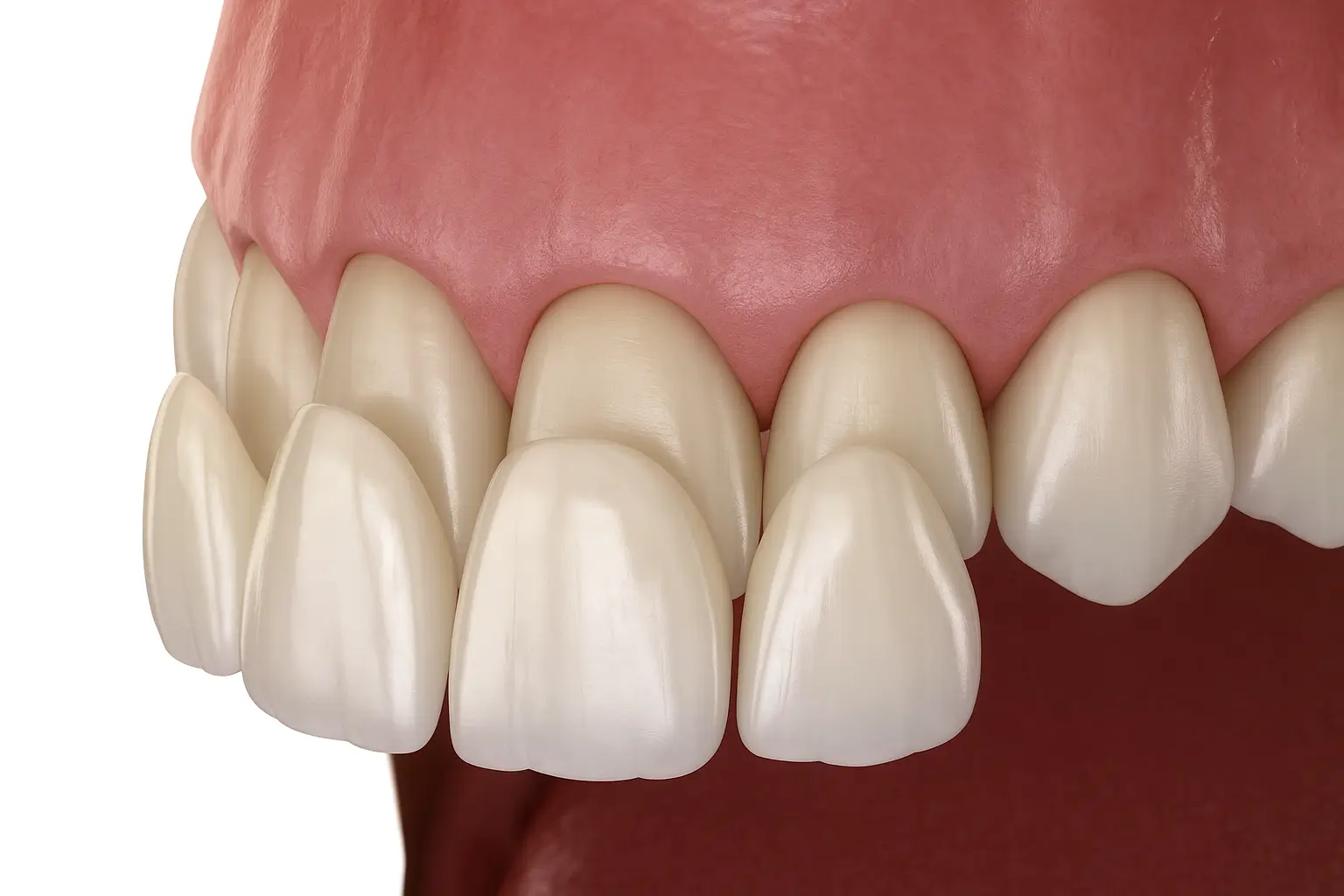 Veneers